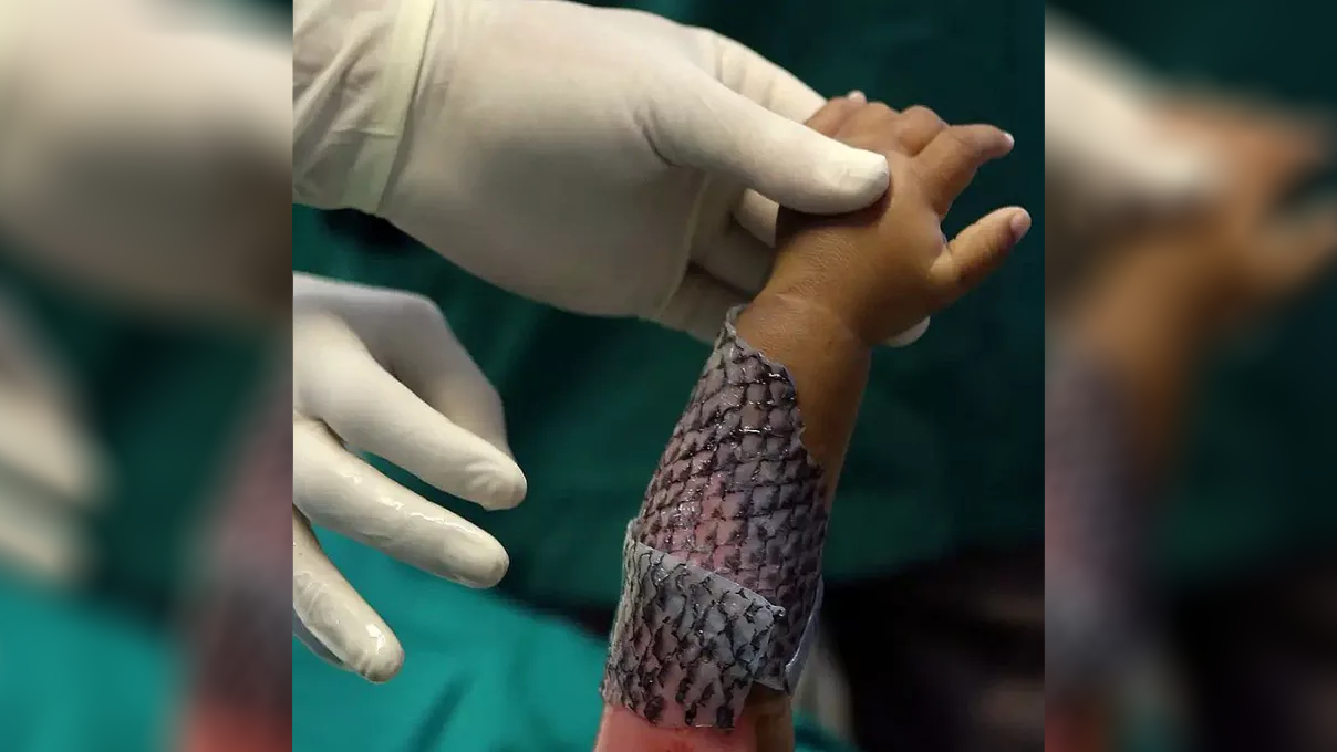 Gloved adult hands tend to a child's arm, which is wrapped in a purple and scaly bandage made from fish skin